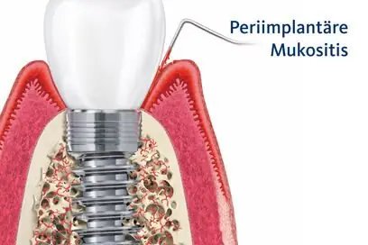 Periimplantäre Mukositis – Zahnfleischentzündung am Implantat (Grafik)