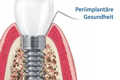 Periimplantäre Gesundheit – gesundes Gewebe um das Zahnimplantat (Grafik)