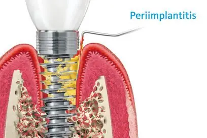 Periimplantitis – Entzündung mit Knochenabbau am Implantat (Grafik)